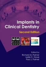 Implants in Clinical Dentistry