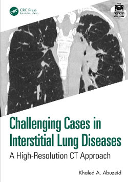 Challenging Cases in Interstitial Lung Diseases Challenging Cases in Interstitial Lung Diseases