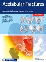 Acetabular Fractures