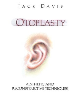 Otoplasty