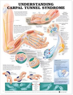 Understanding Carpal Tunnel Syndrome Anatomical Chart Understanding Carpal Tunnel Syndrome Anatomical Chart