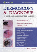 Dermoscopy and Diagnosis of Benign and Malignant Skin Lesions