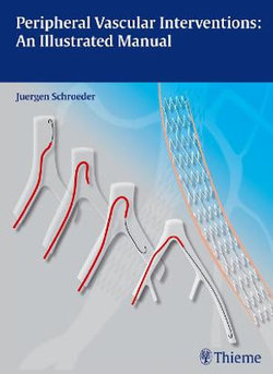 Peripheral Vascular Interventions: an Illustrated Manual