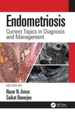 Endometriosis Endometriosis
