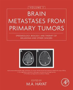 Brain Metastases from Primary Tumors, Volume 3