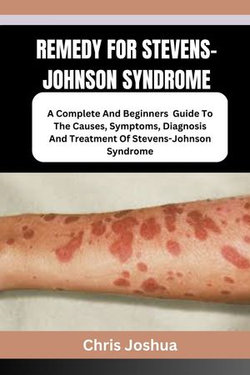 REMEDY FOR STEVENS-JOHNSON SYNDROME REMEDY FOR STEVENS-JOHNSON SYNDROME