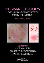 Dermatoscopy of Non-Pigmented Skin Tumors