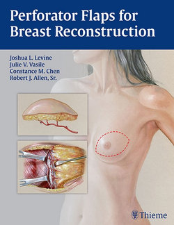 Perforator Flaps for Breast Reconstruction