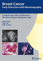 Breast Cancer: Early Detection with Mammography