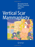 Vertical Scar Mammaplasty